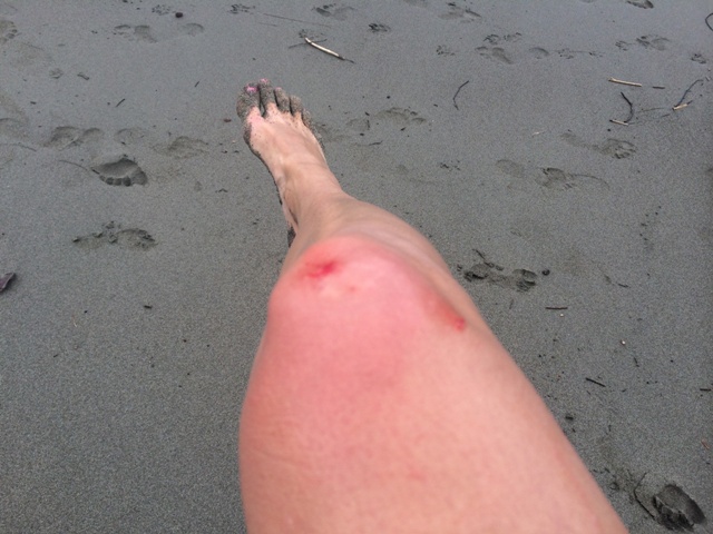 Kneed injury while learning to surf in Costa Rica